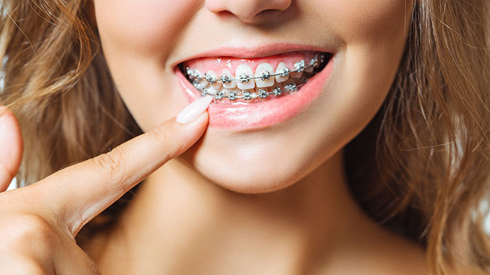 Sabit ve Hareketli Apareyler